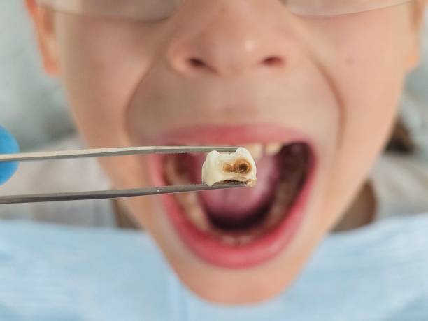 Best Emergency Dental Care for Broken or Chipped Teeth in Clearlake, CA